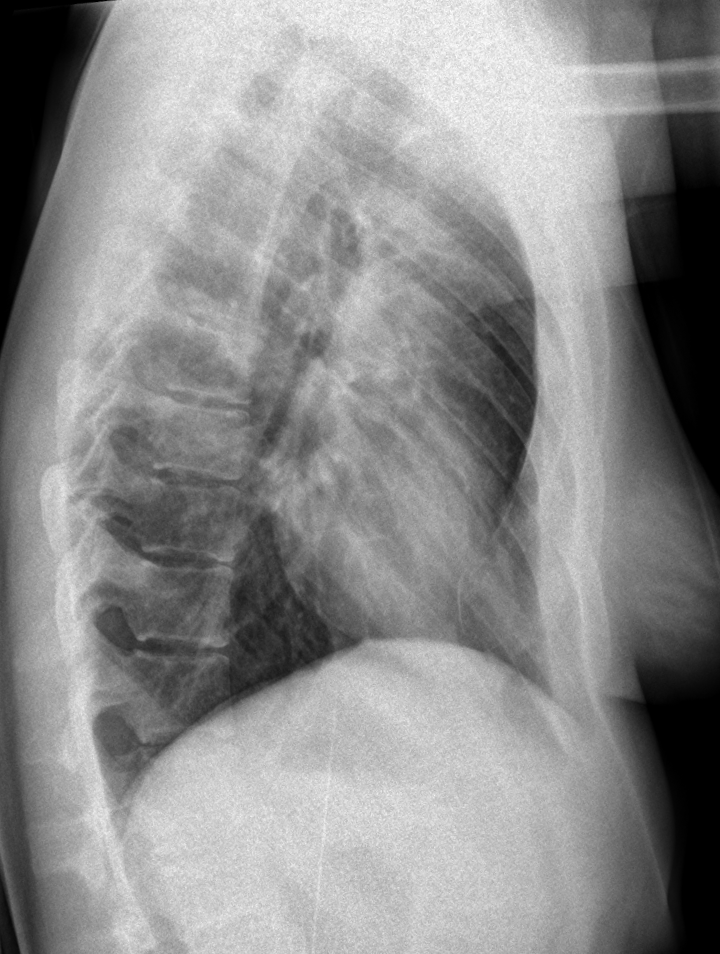 Dissecting Lower Back Pain: Diffuse Idiopathic Skeletal Hyperostosis (DISH)